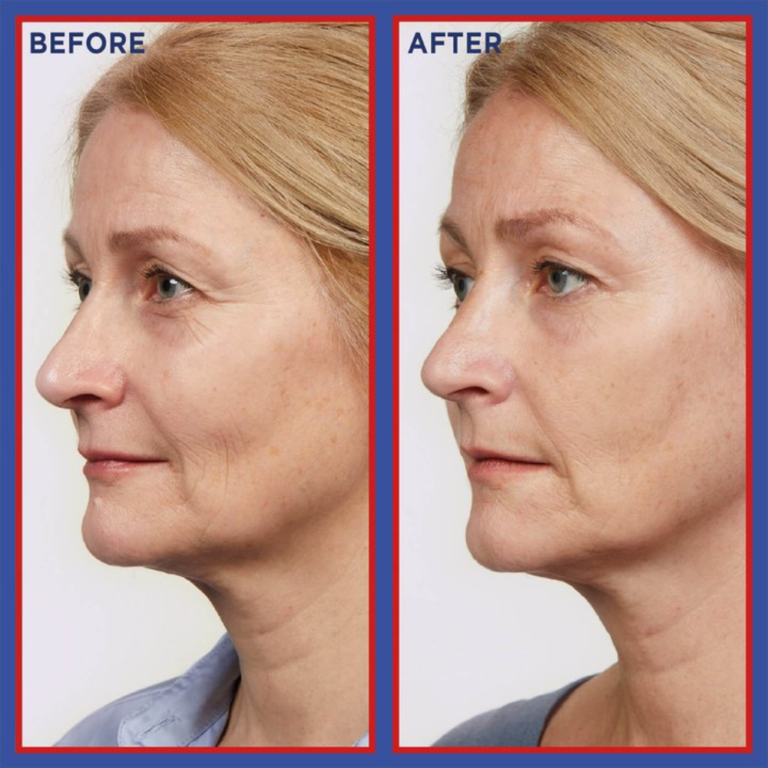 Loreal Revitalift Laser Pure Retinol Night Serum thumbnail 2